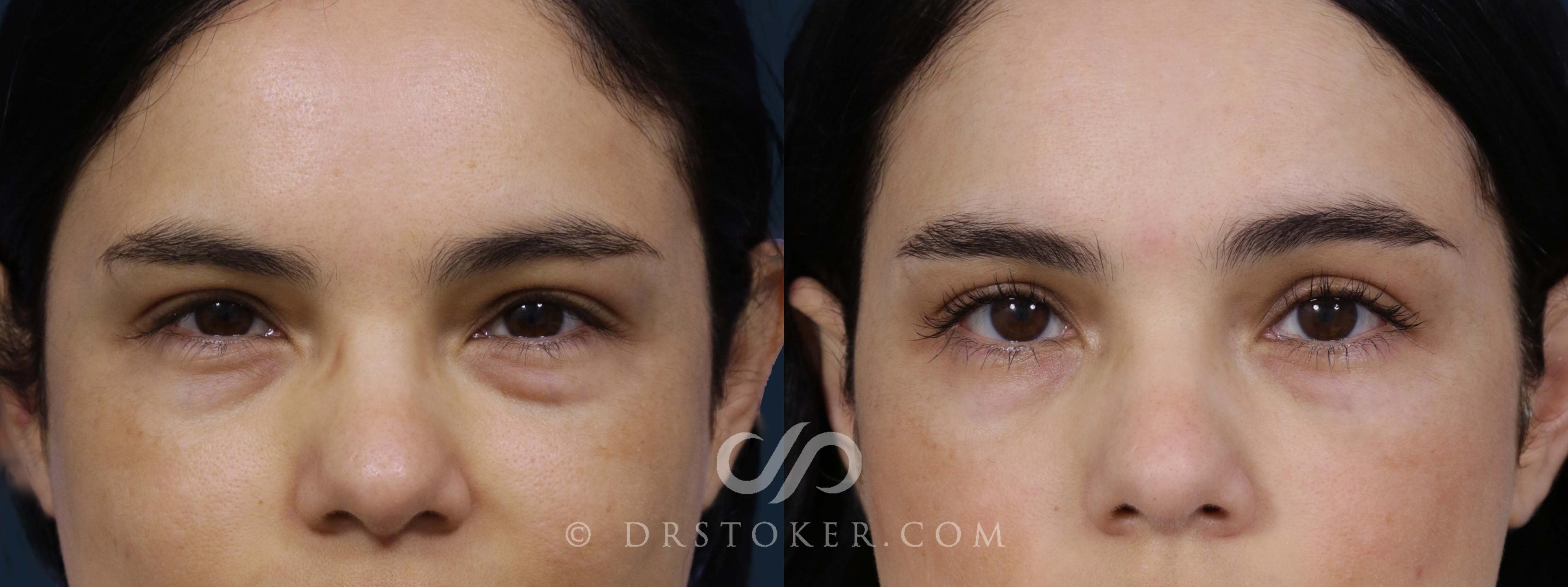 Before & After Eyelid Surgery Case 1926 Front View in Los Angeles, CA
