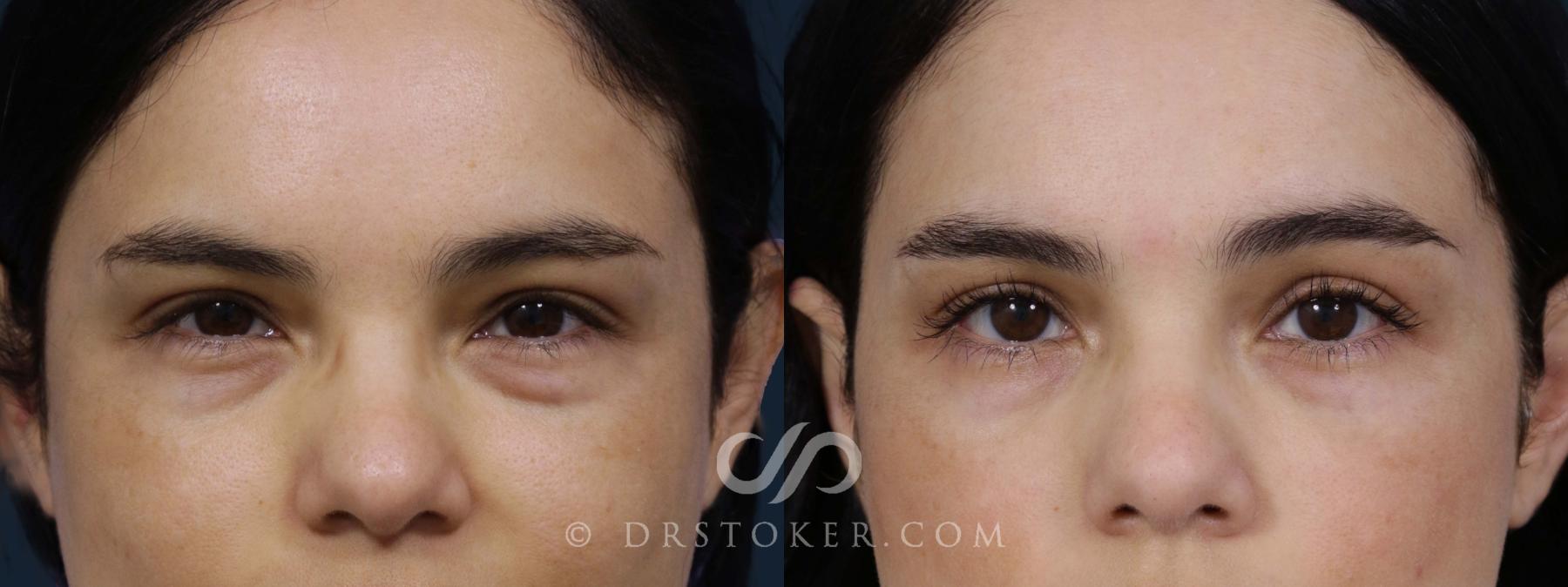 Before & After Eyelid Surgery Case 1926 Front View in Los Angeles, CA
