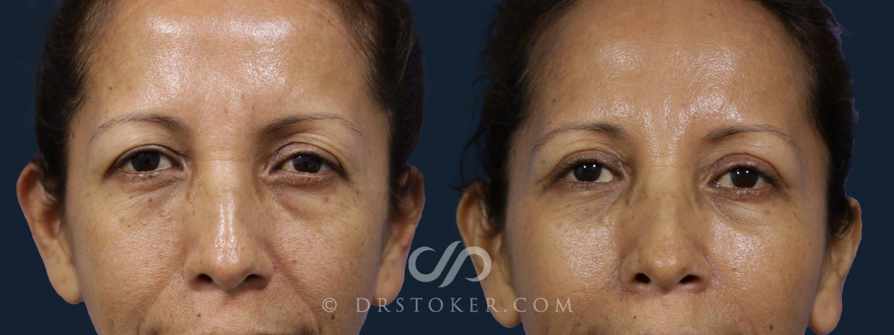 Before & After Eyelid Surgery Case 1942 Front View in Los Angeles, CA