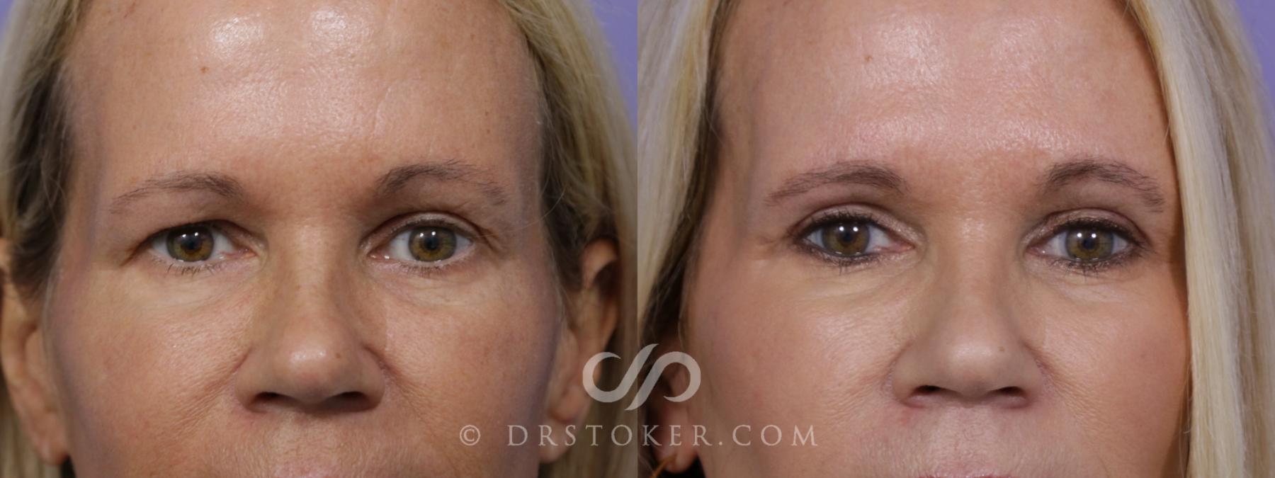 Before & After Eyelid Surgery Case 1980 Front View in Los Angeles, CA