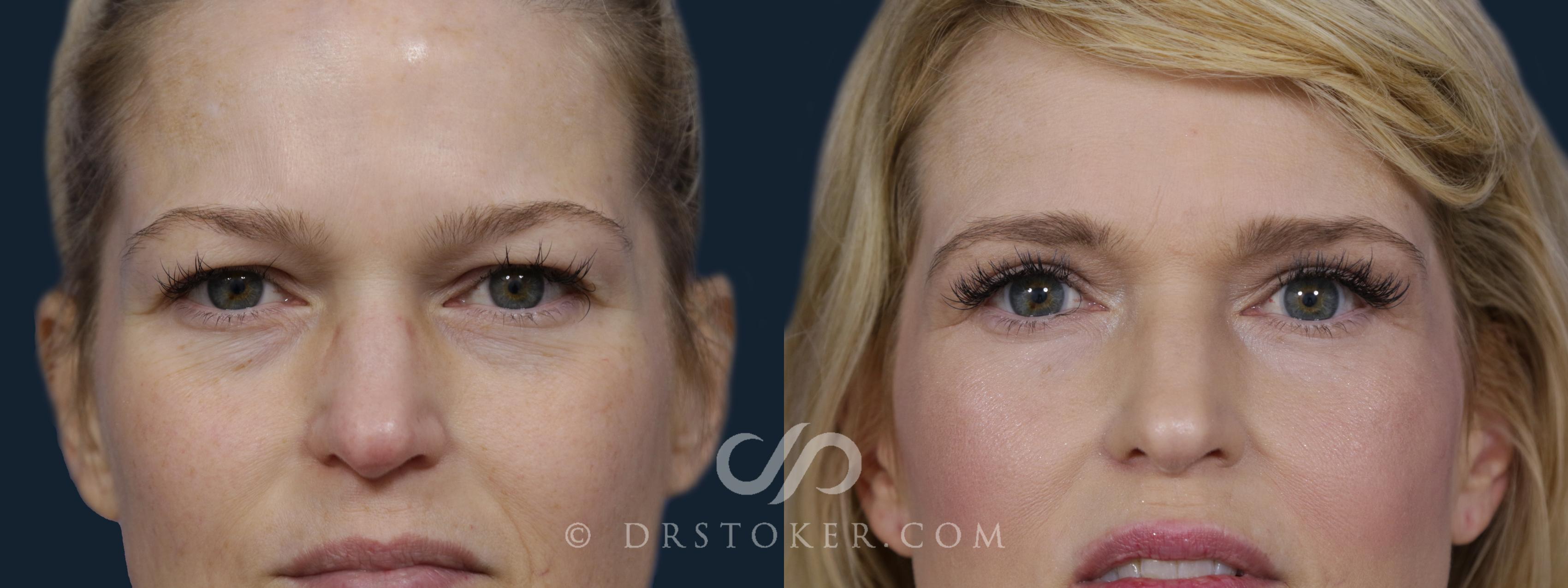 Before & After Eyelid Surgery Case 1983 Front View in Los Angeles, CA