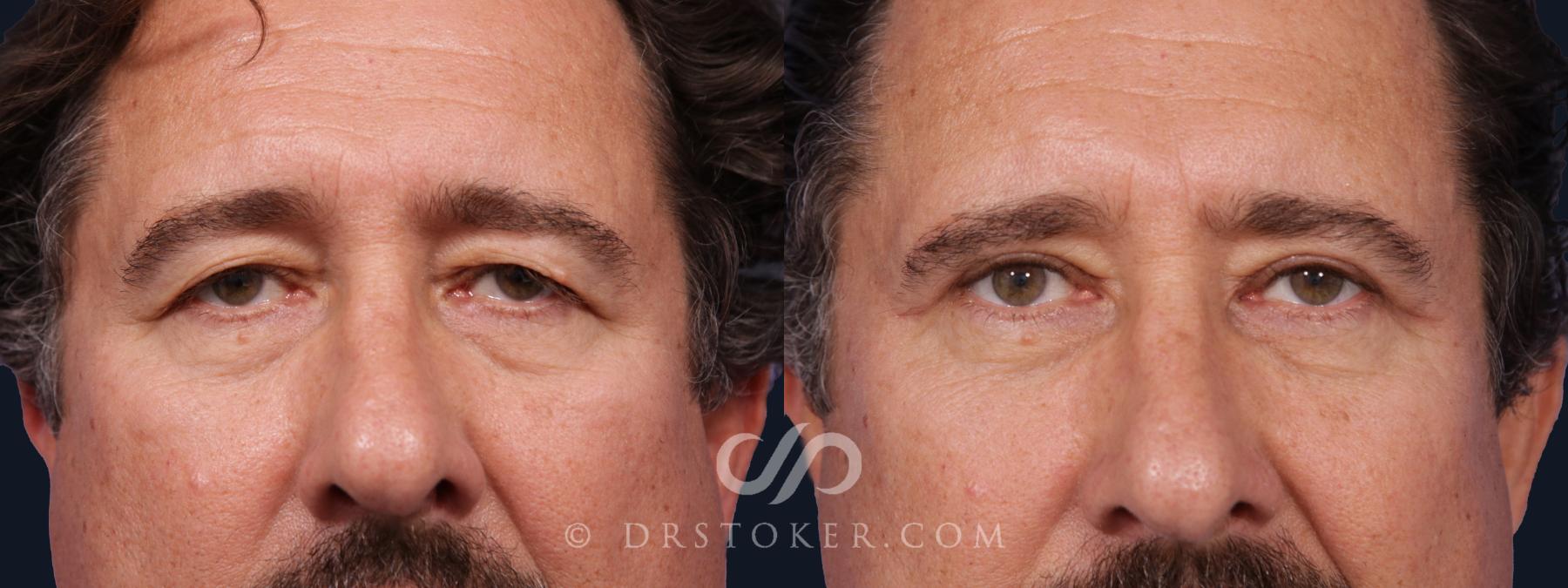 Before & After Eyelid Surgery Case 2063 Front View in Los Angeles, CA