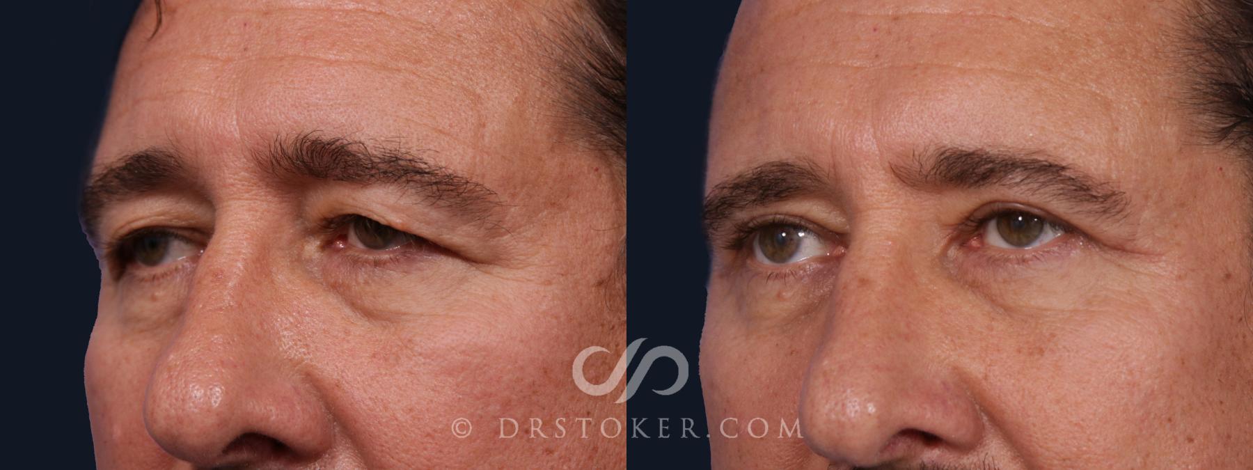 Before & After Eyelid Surgery Case 2063 Left Oblique View in Los Angeles, CA