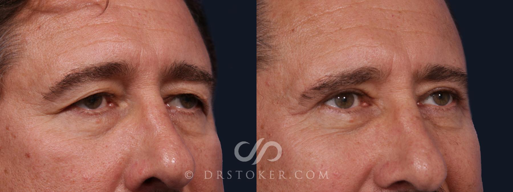 Before & After Eyelid Surgery Case 2063 Right Oblique View in Los Angeles, CA