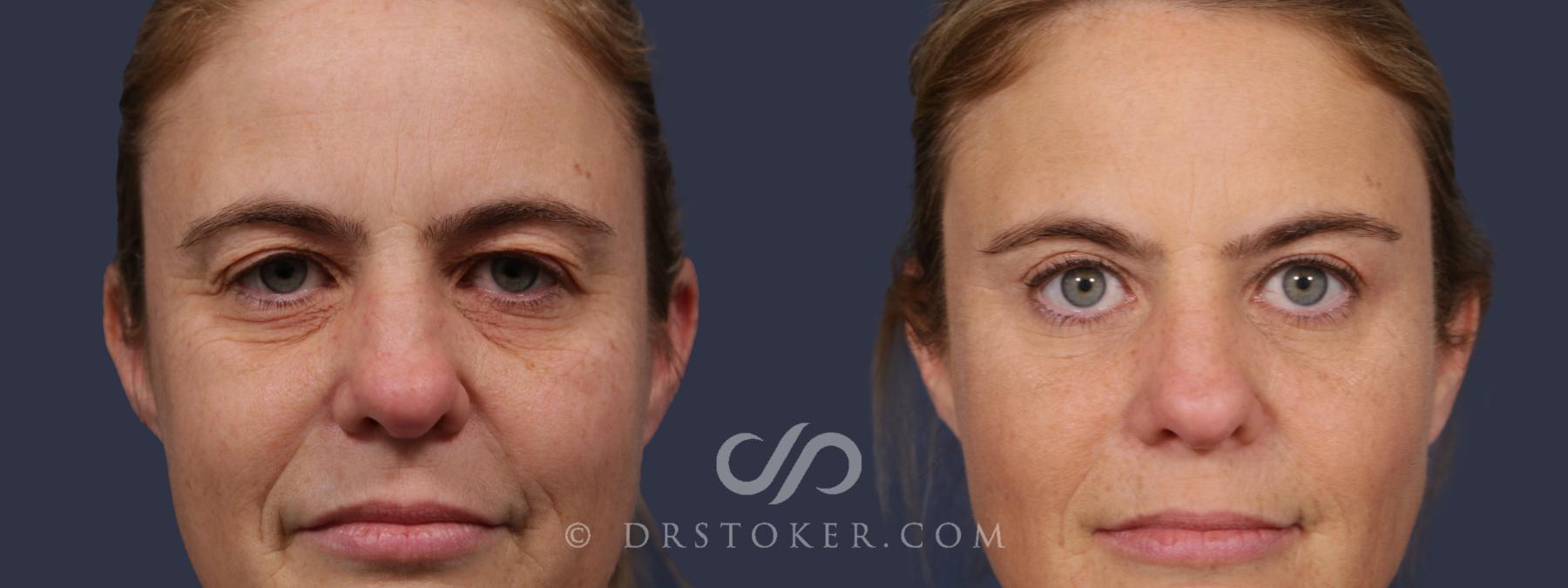 Before & After Eyelid Surgery Case 2074 Front View in Los Angeles, CA
