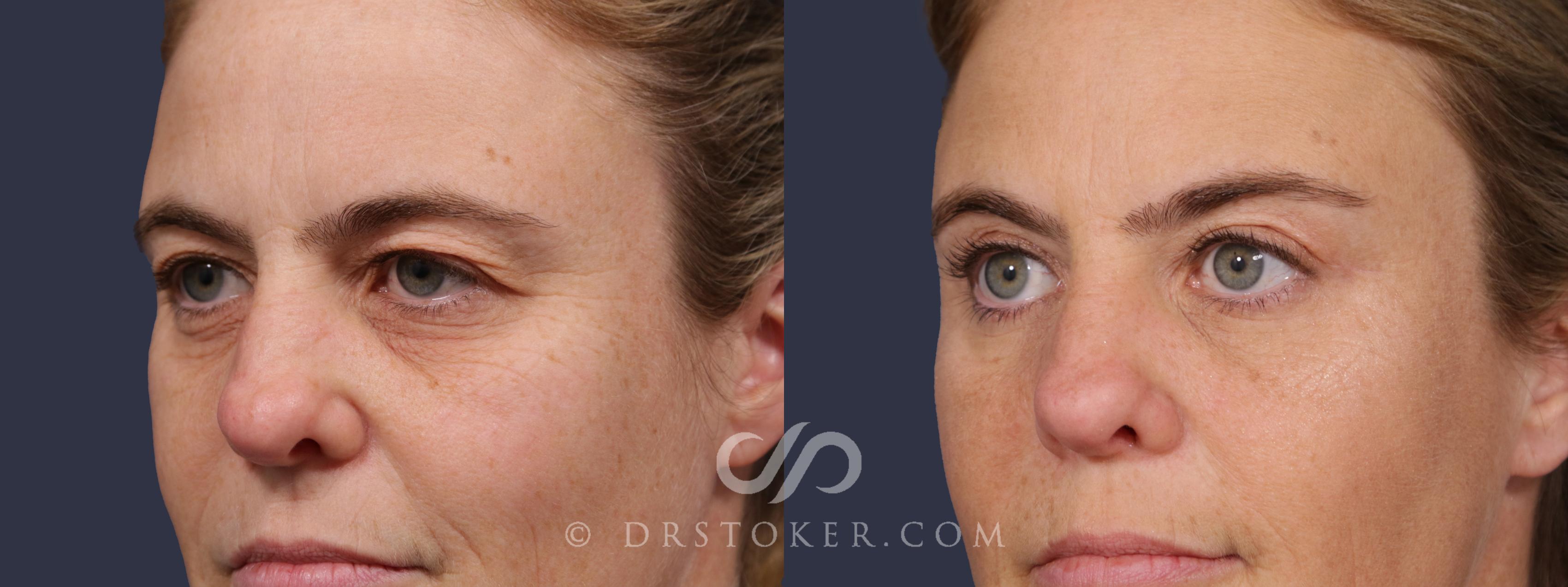 Before & After Eyelid Surgery Case 2074 Left Oblique View in Los Angeles, CA