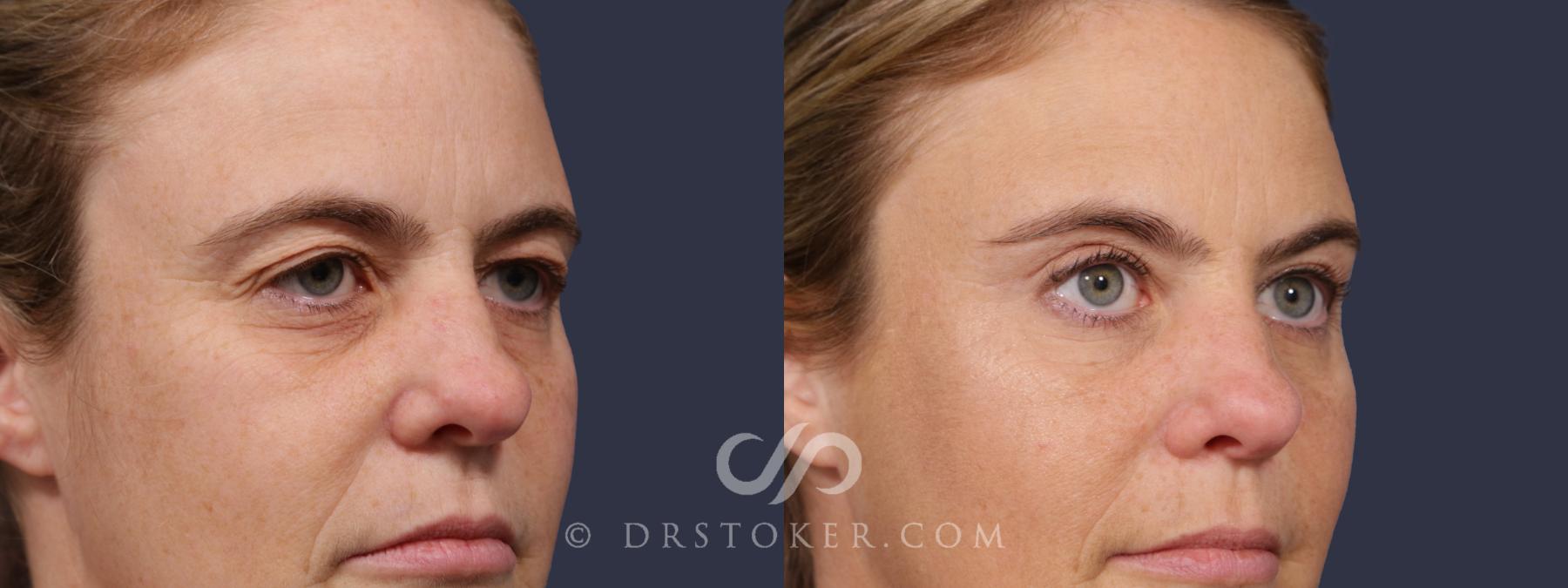 Before & After Eyelid Surgery Case 2074 Right Oblique View in Los Angeles, CA