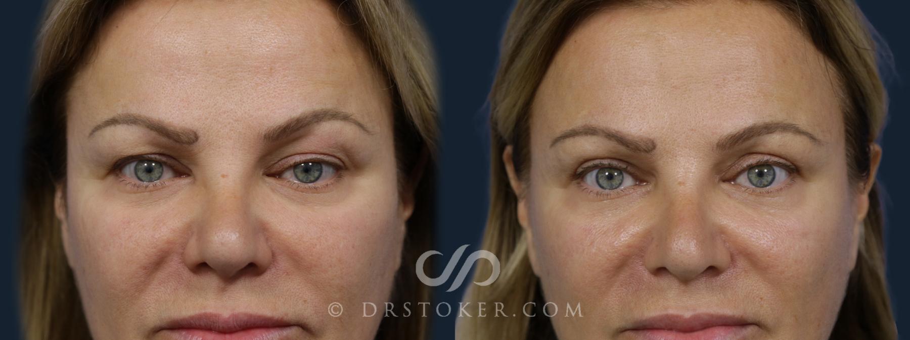 Before & After Eyelid Surgery Case 2083 Front View in Los Angeles, CA