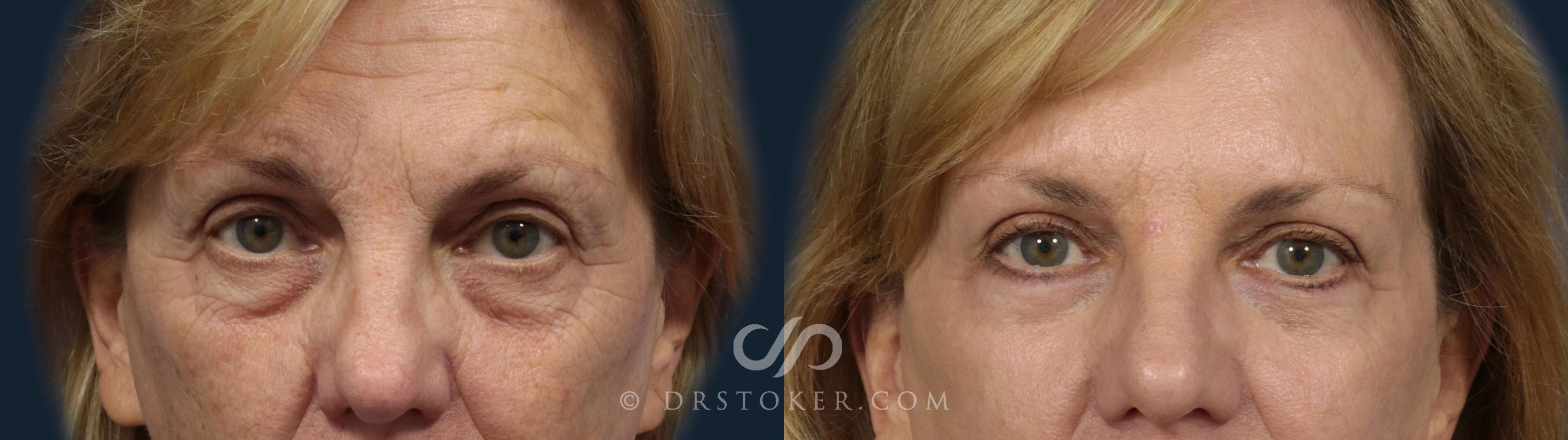 Before & After Eyelid Surgery Case 2087 Front View in Los Angeles, CA