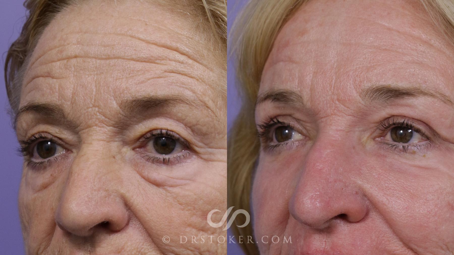 Before & After Eyelid Surgery Case 2092 Left Oblique View in Los Angeles, CA