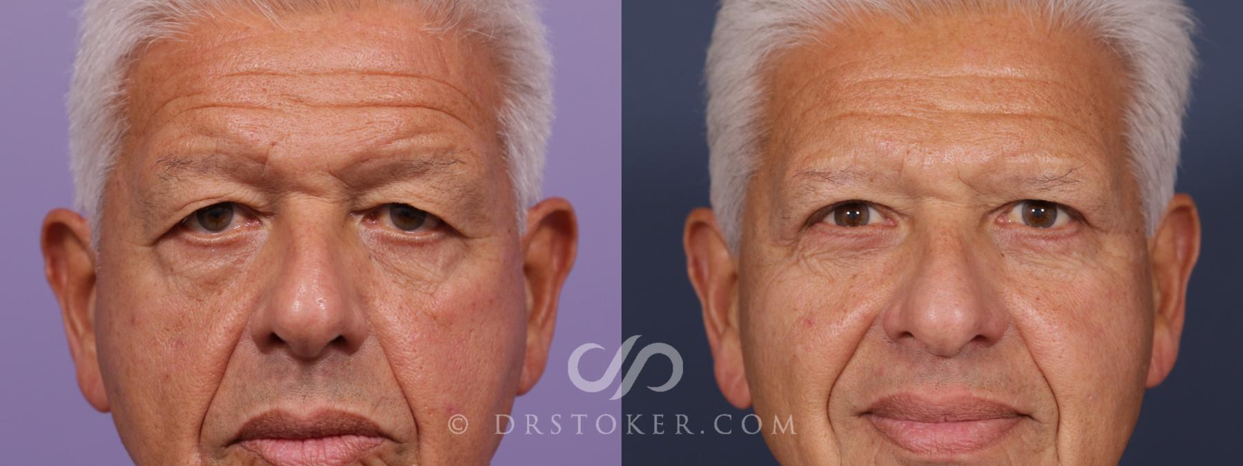Before & After Eyelid Surgery for Men Case 2094 Front View in Los Angeles, CA
