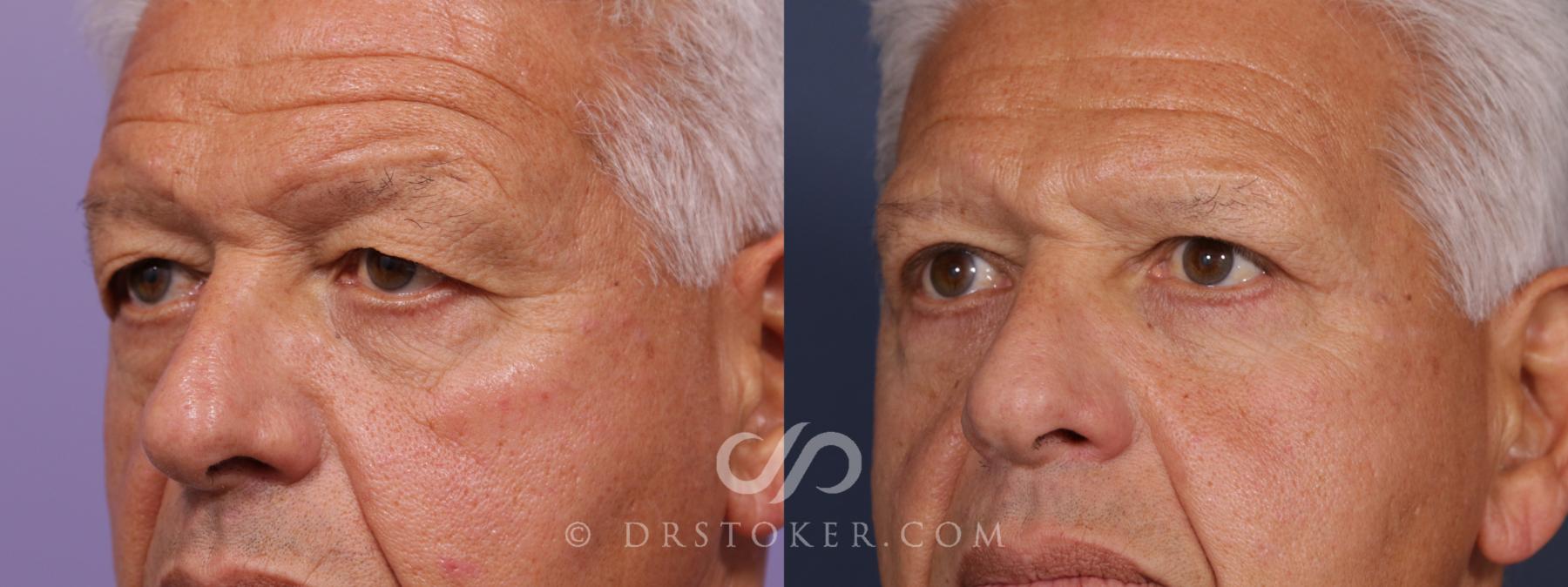 Before & After Eyelid Surgery for Men Case 2094 Left Oblique View in Los Angeles, CA