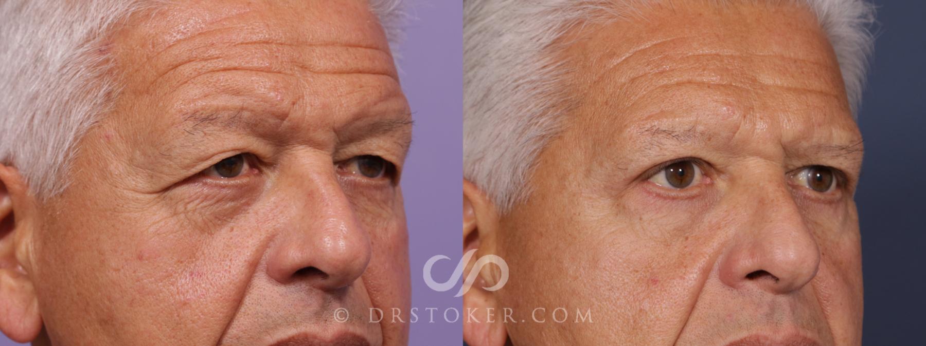 Before & After Eyelid Surgery for Men Case 2094 Right Oblique View in Los Angeles, CA