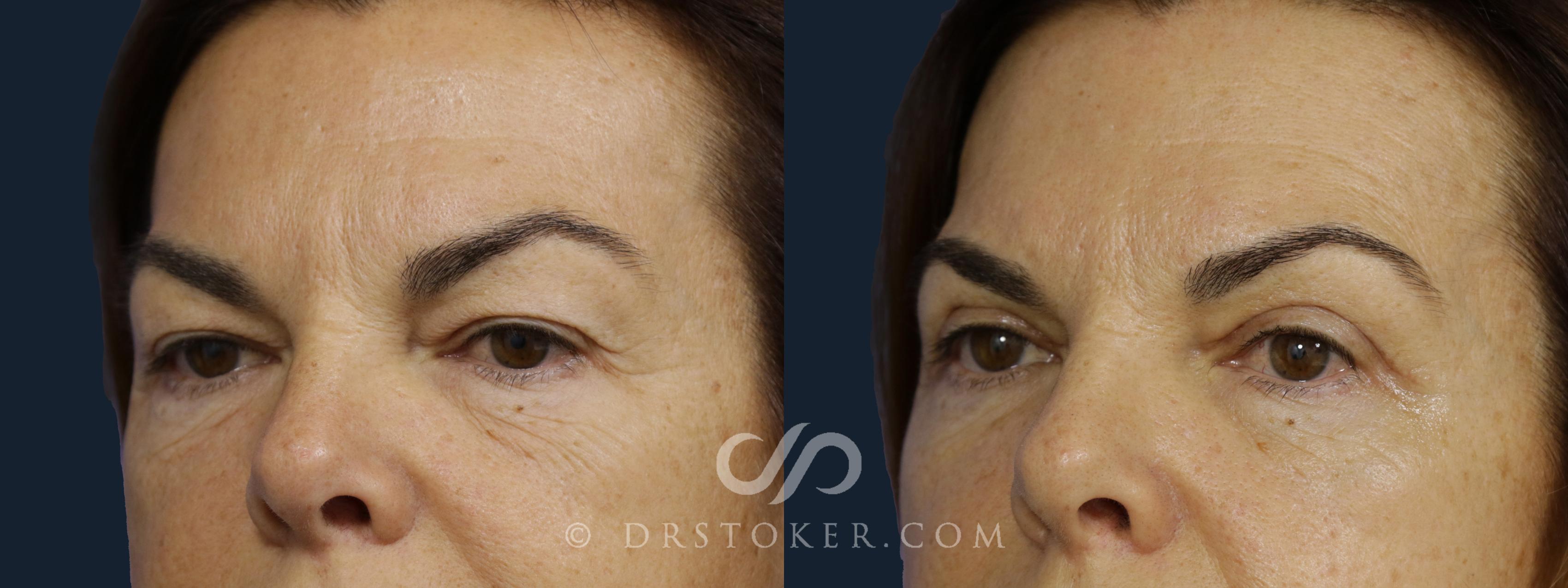 Before & After Eyelid Surgery Case 2104 Left Oblique View in Los Angeles, CA