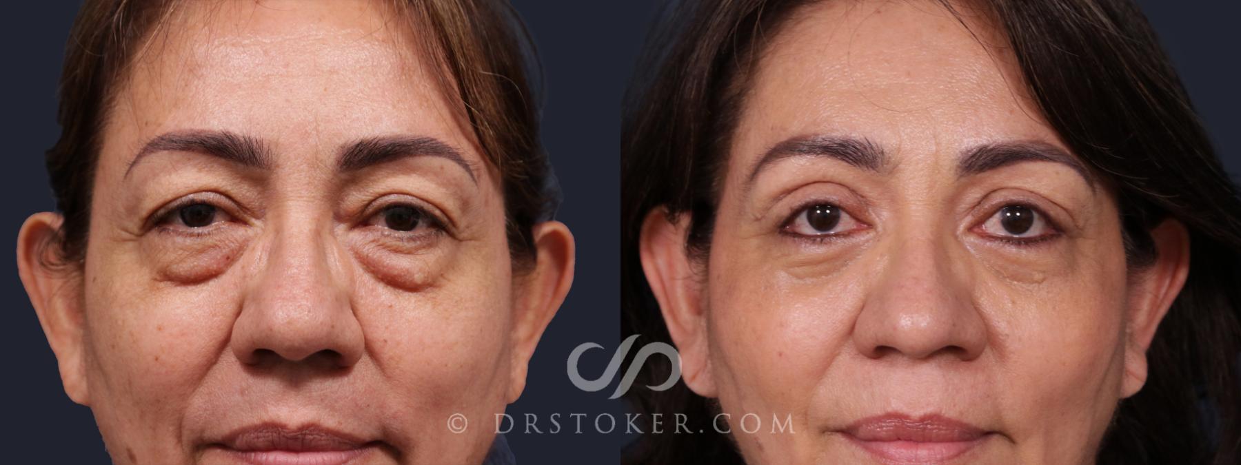 Before & After Eyelid Surgery Case 2142 Front View in Los Angeles, CA