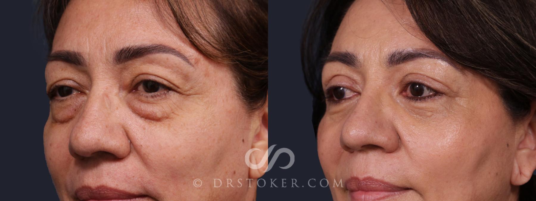 Before & After Eyelid Surgery Case 2142 Left Oblique View in Los Angeles, CA