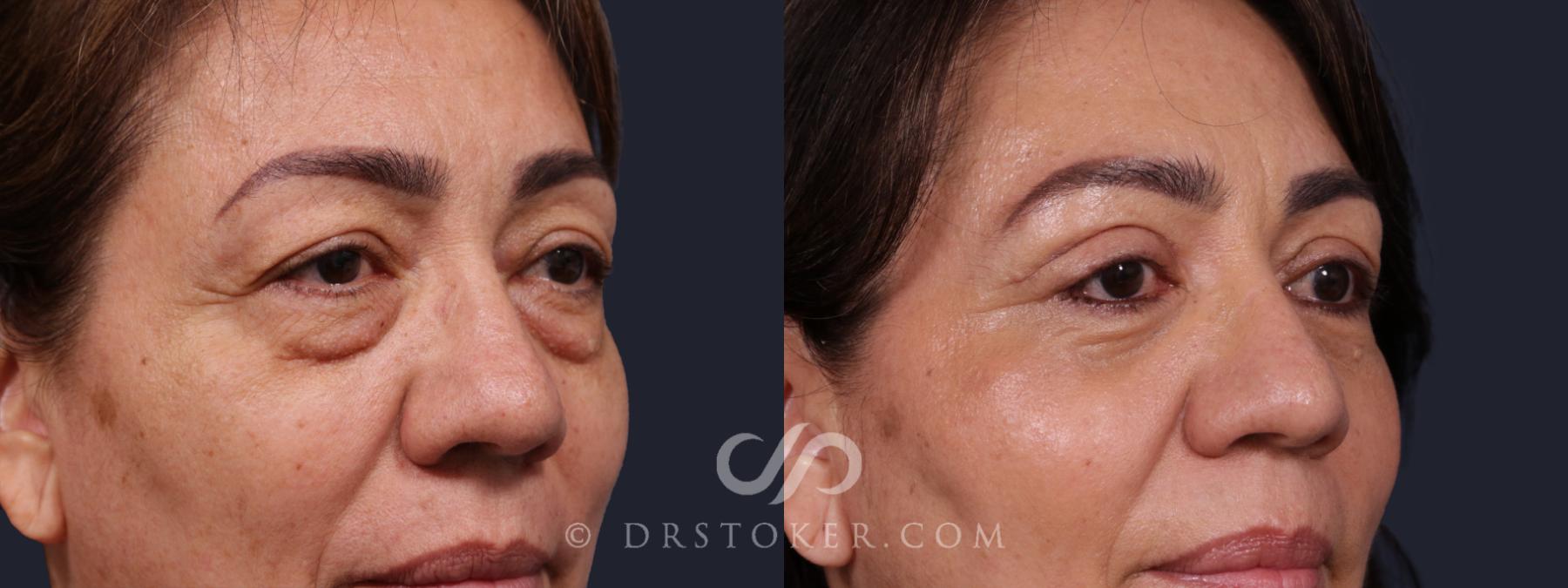 Before & After Eyelid Surgery Case 2142 Right Oblique View in Los Angeles, CA