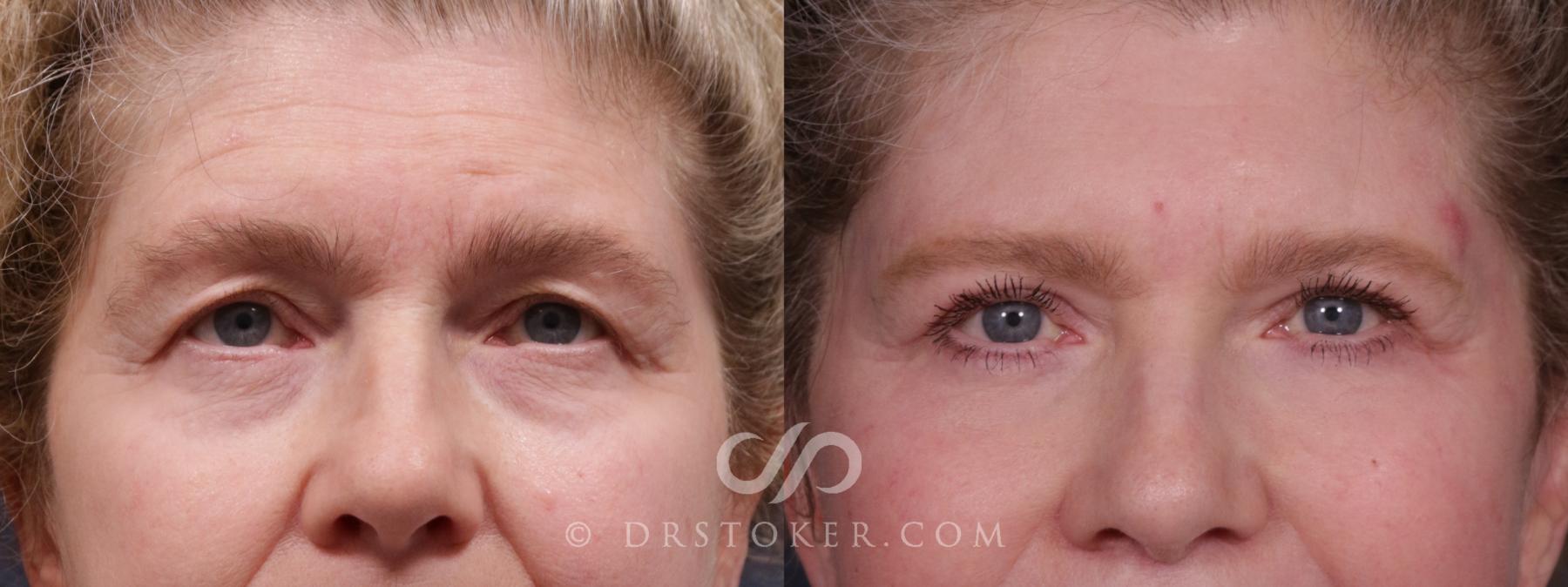 Before & After Eyelid Surgery Case 2160 Front View in Los Angeles, CA