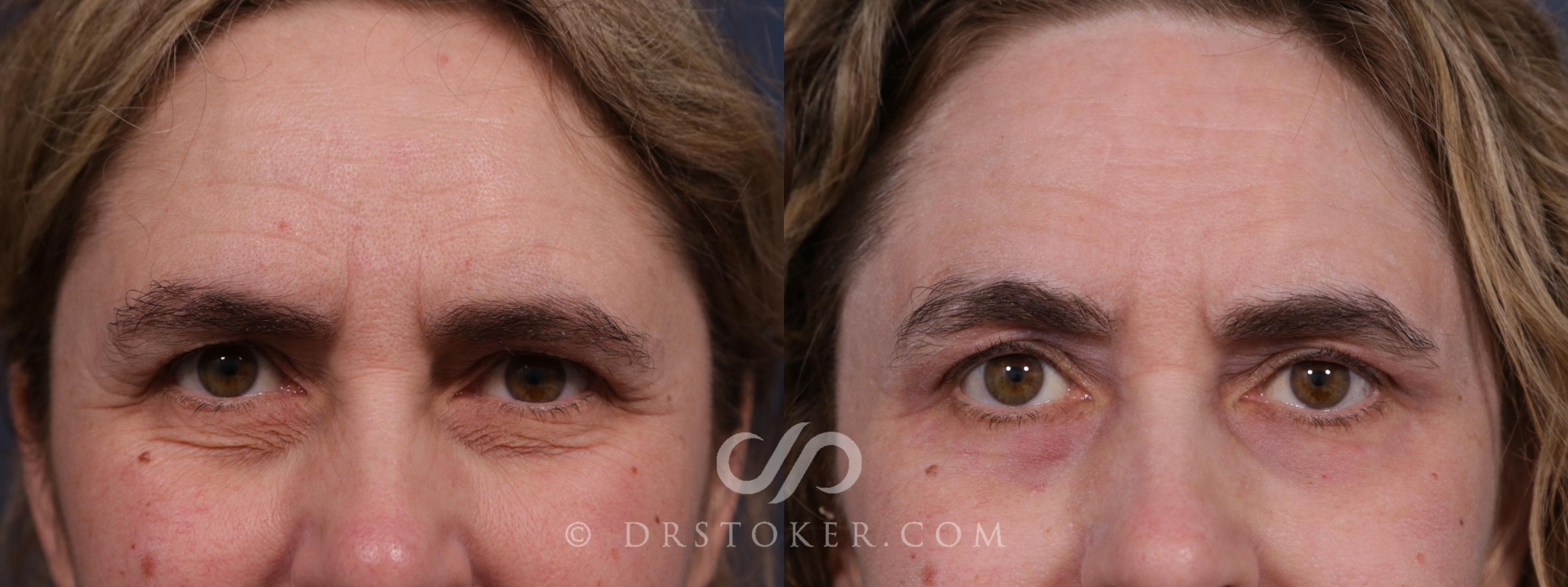 Before & After Eyelid Surgery Case 2163 Front View in Los Angeles, CA