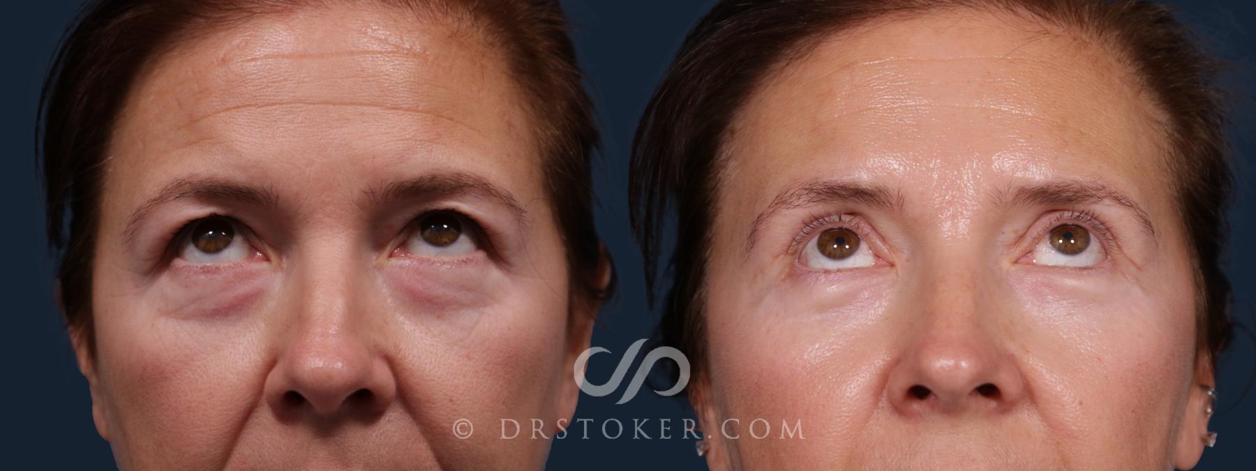 Before & After Eyelid Surgery Case 2181 Front View in Los Angeles, CA