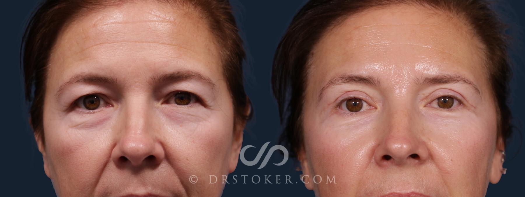 Before & After Eyelid Surgery Case 2181 Front_1 View in Los Angeles, CA