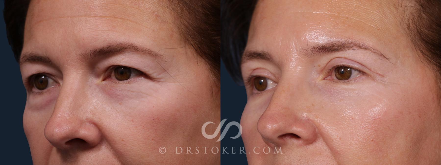Before & After Eyelid Surgery Case 2181 Left Oblique View in Los Angeles, CA