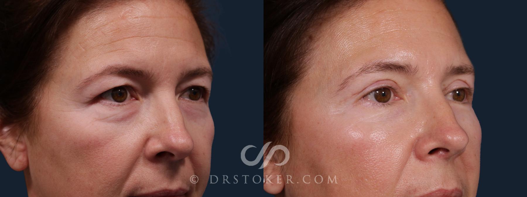 Before & After Eyelid Surgery Case 2181 Right Oblique View in Los Angeles, CA