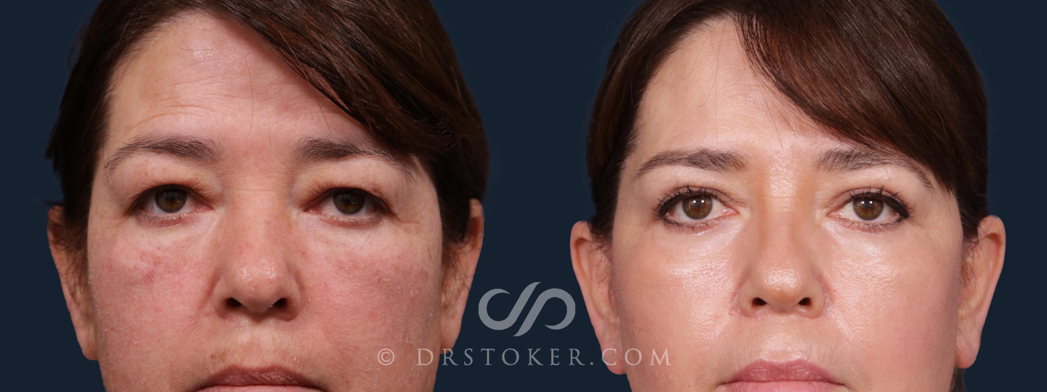 Before & After Eyelid Surgery Case 2185 Front View in Los Angeles, CA