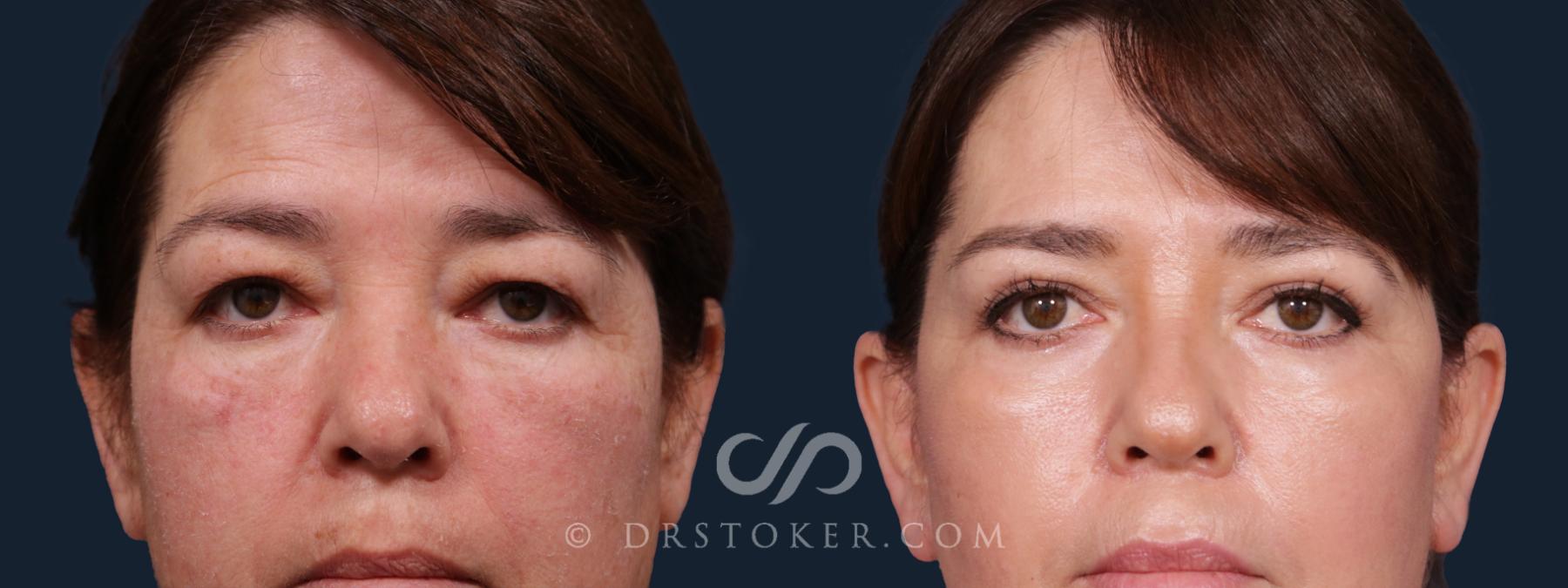 Before & After Eyelid Surgery Case 2185 Front View in Los Angeles, CA
