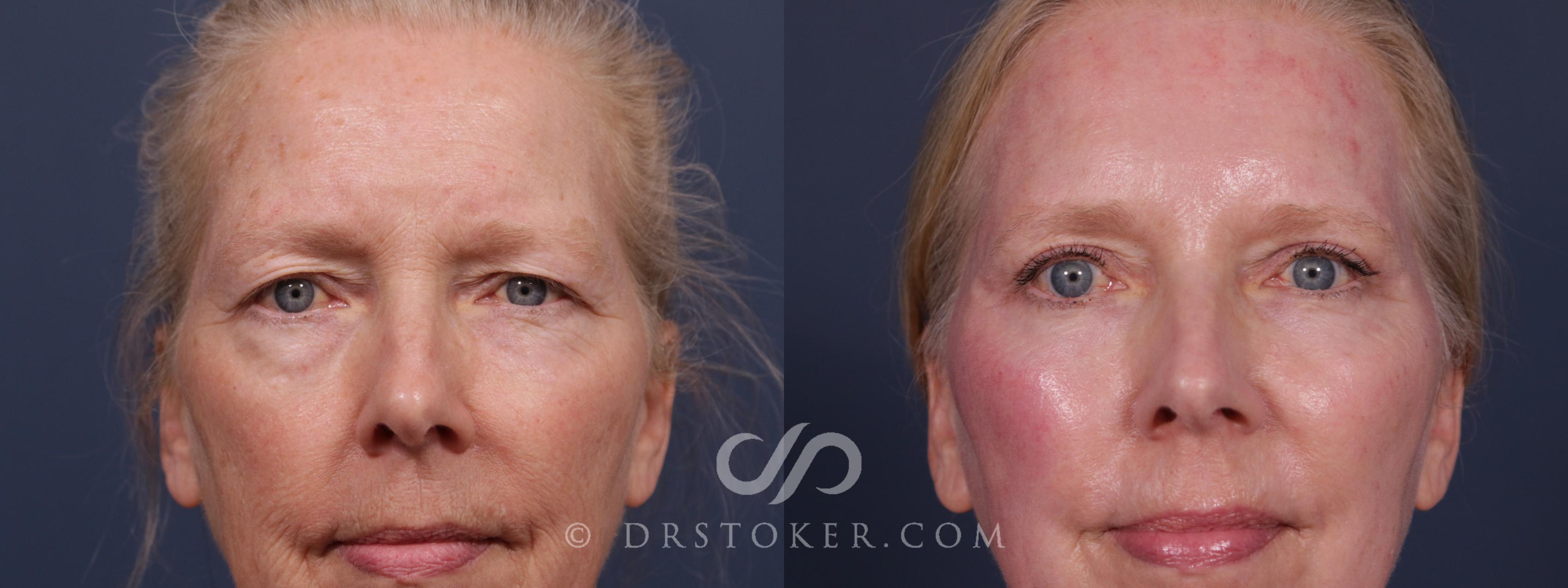 Before & After Eyelid Surgery Case 2190 Front View in Los Angeles, CA