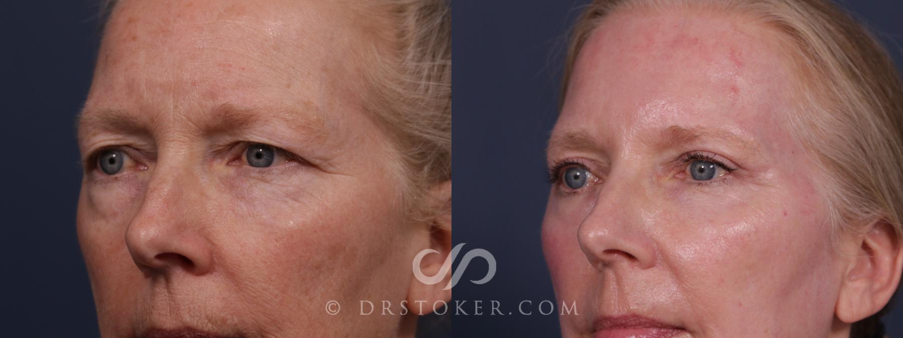 Before & After Eyelid Surgery Case 2190 Left Oblique View in Los Angeles, CA