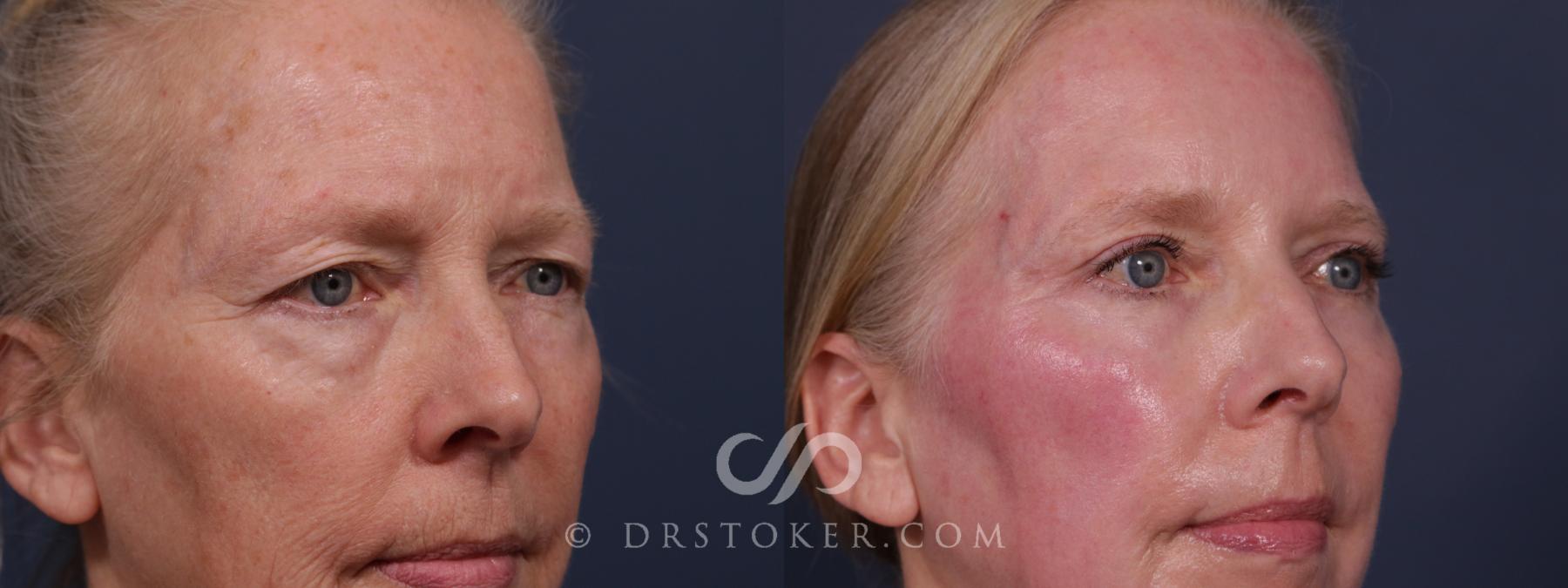 Before & After Laser Skin Resurfacing  Case 2190 Right Oblique View in Los Angeles, CA