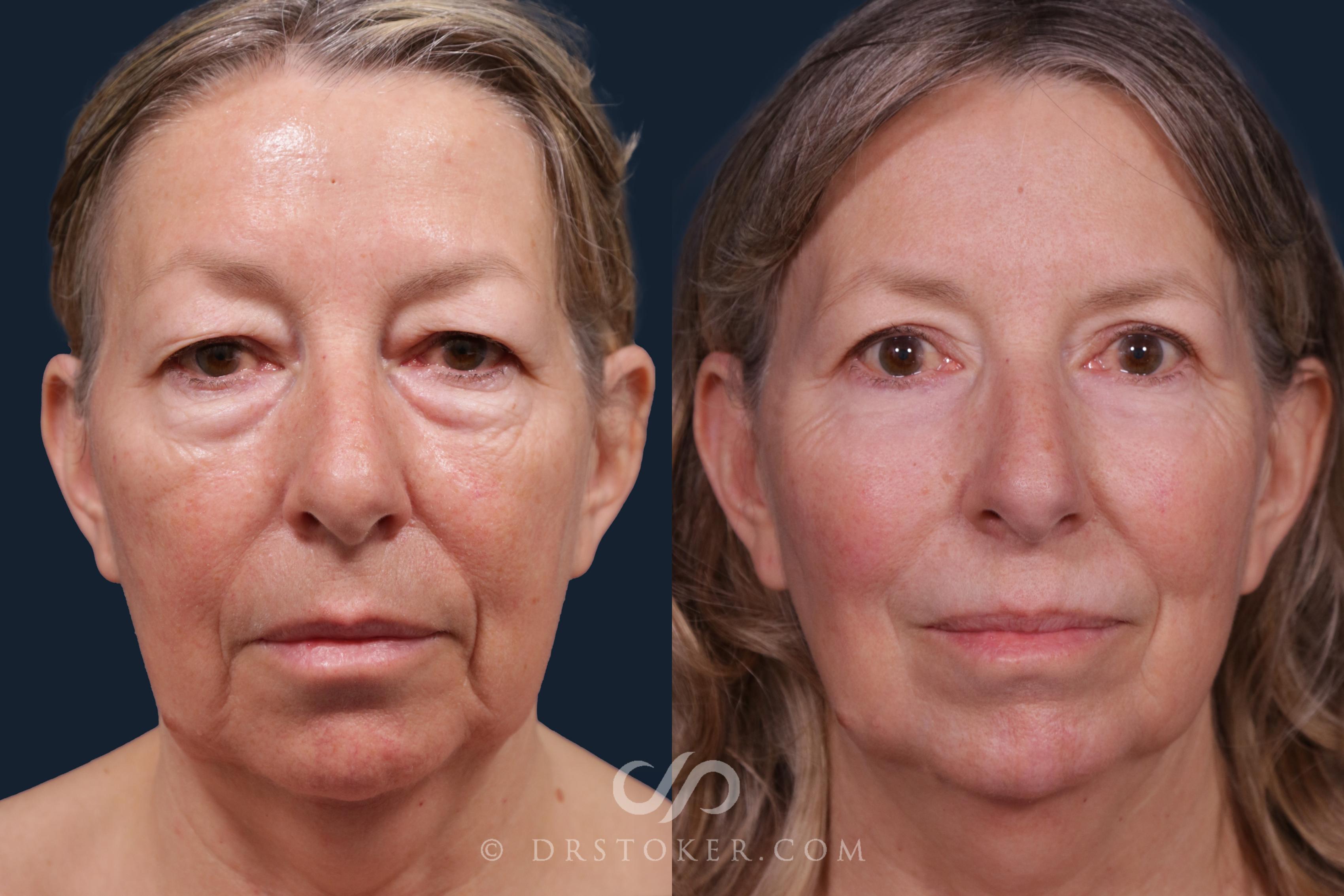 Before & After Eyelid Surgery Case 2210 Front View in Los Angeles, CA