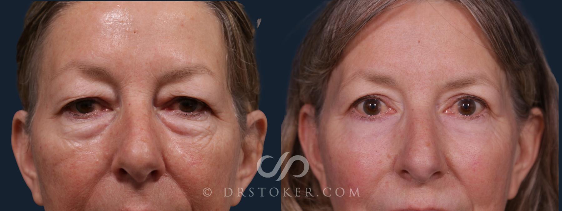Before & After Eyelid Surgery Case 2211 Front Eyes  View in Los Angeles, CA