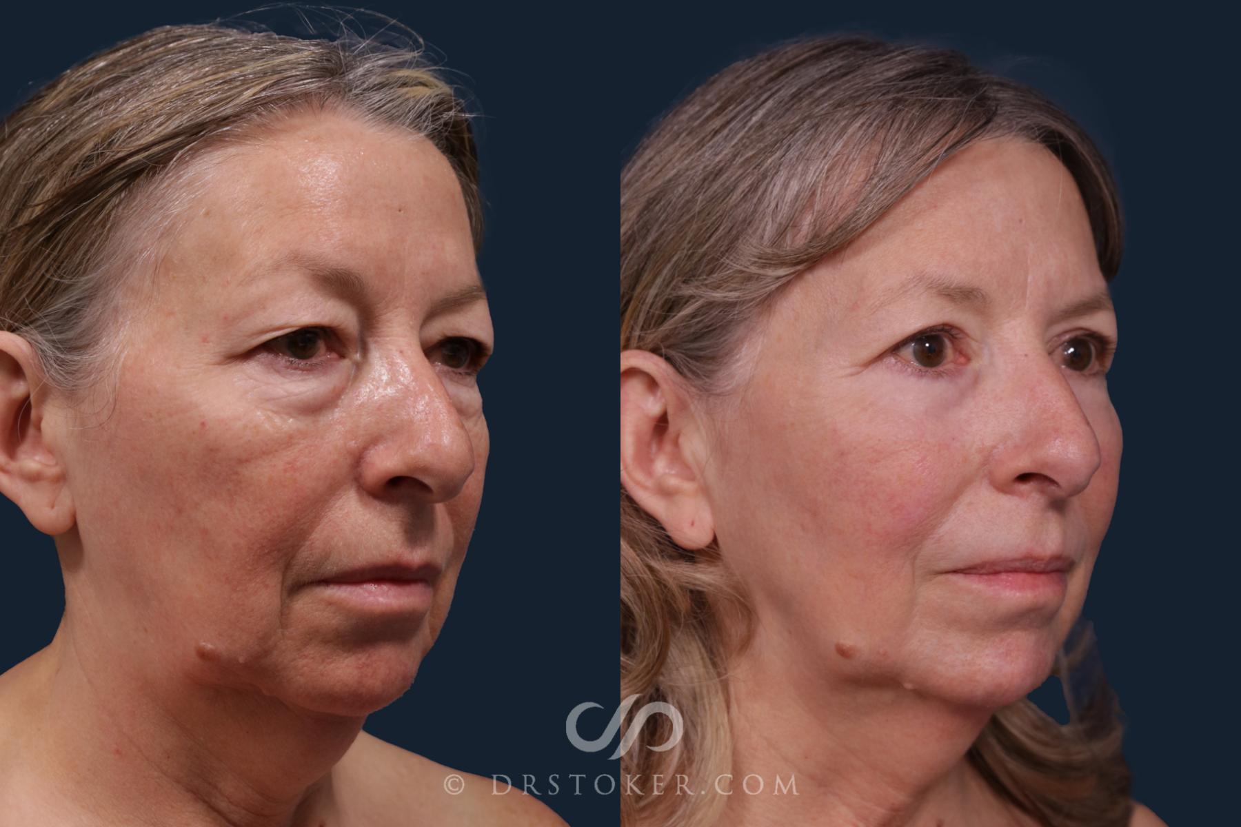 Before & After Eyelid Surgery Case 2211 Right Oblique View in Los Angeles, CA