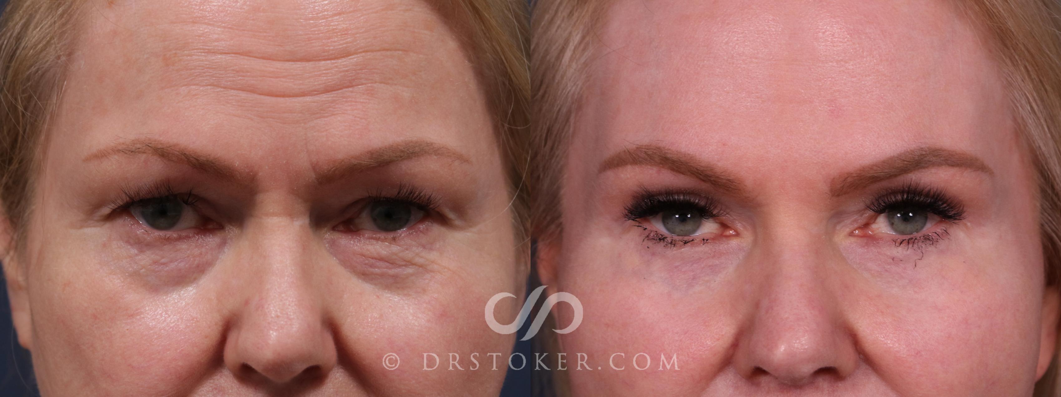 Before & After Eyelid Surgery Case 2304 Front View in Los Angeles, CA