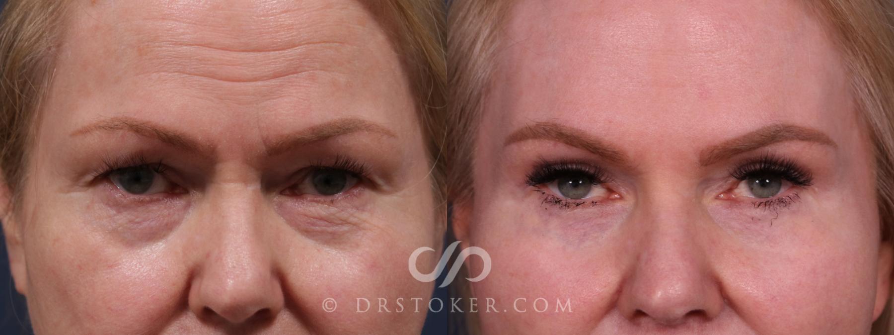 Before & After Eyelid Surgery Case 2304 Front View in Los Angeles, CA