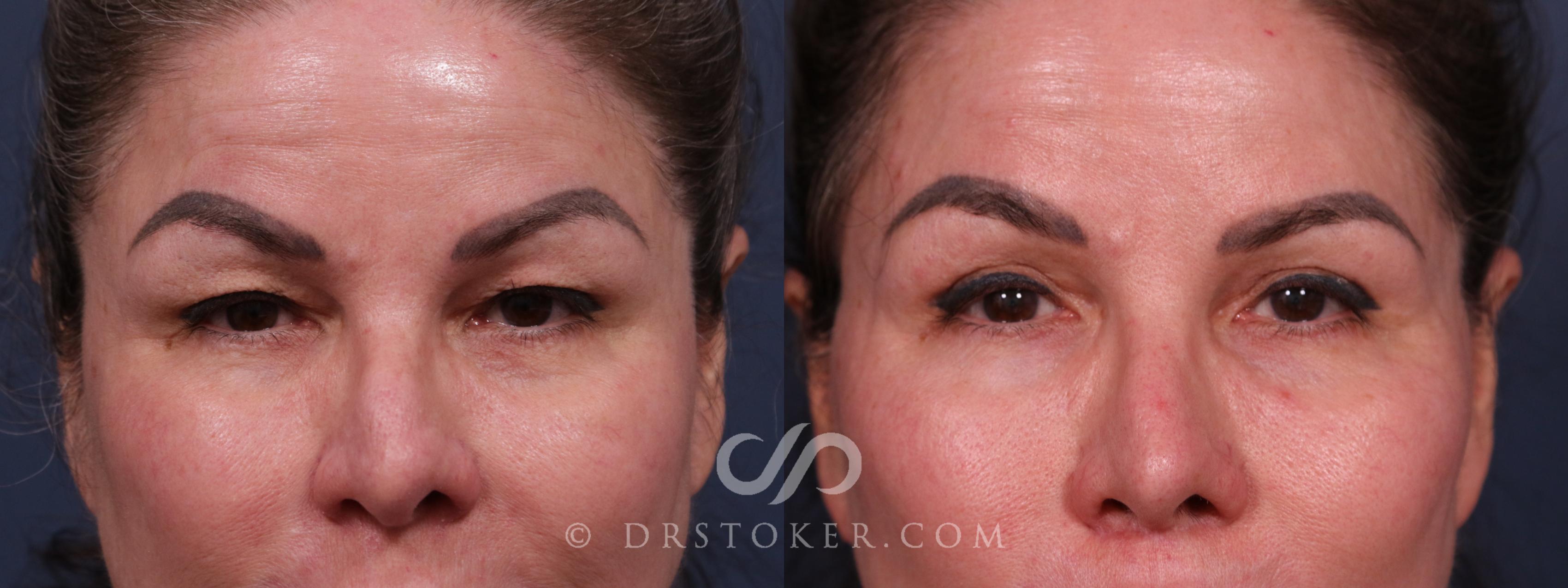 Before & After Eyelid Surgery Case 2317 Front View in Los Angeles, CA