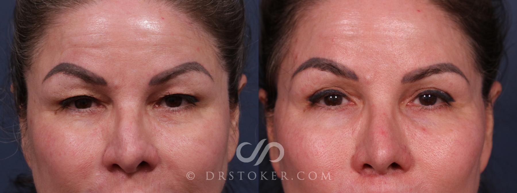 Before & After Eyelid Surgery Case 2317 Front View in Los Angeles, CA