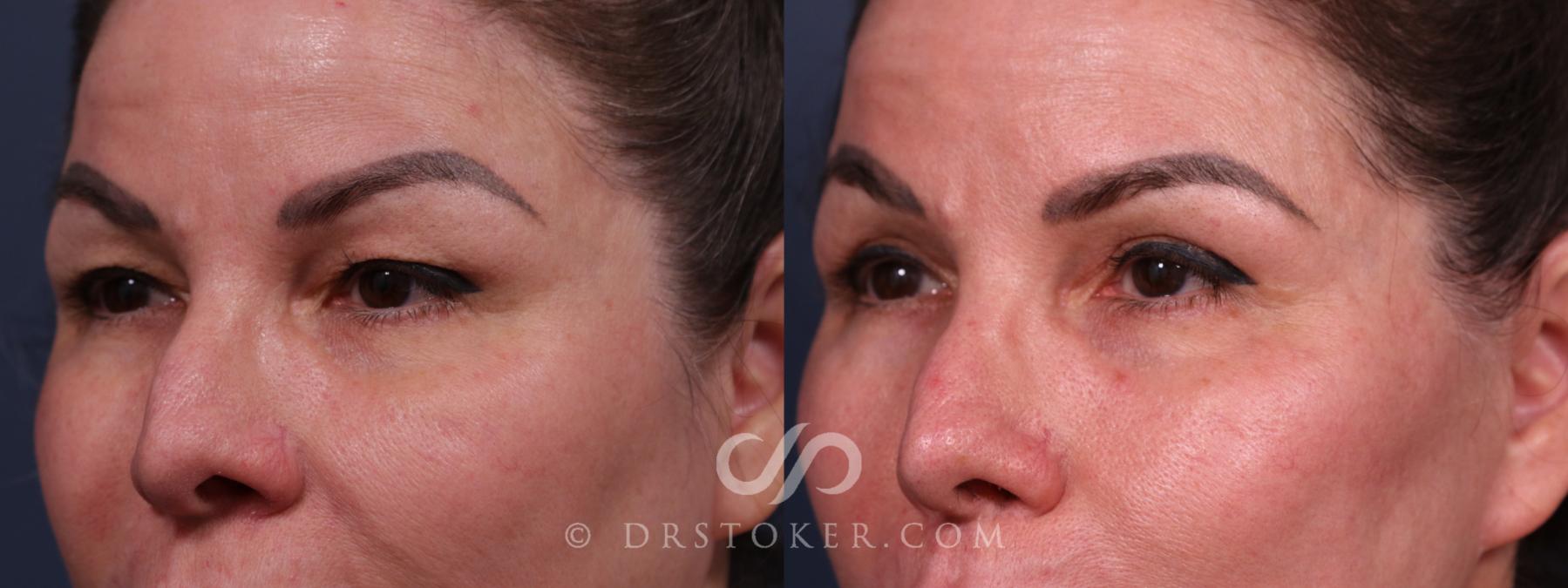 Before & After Eyelid Surgery Case 2317 Left Oblique View in Los Angeles, CA