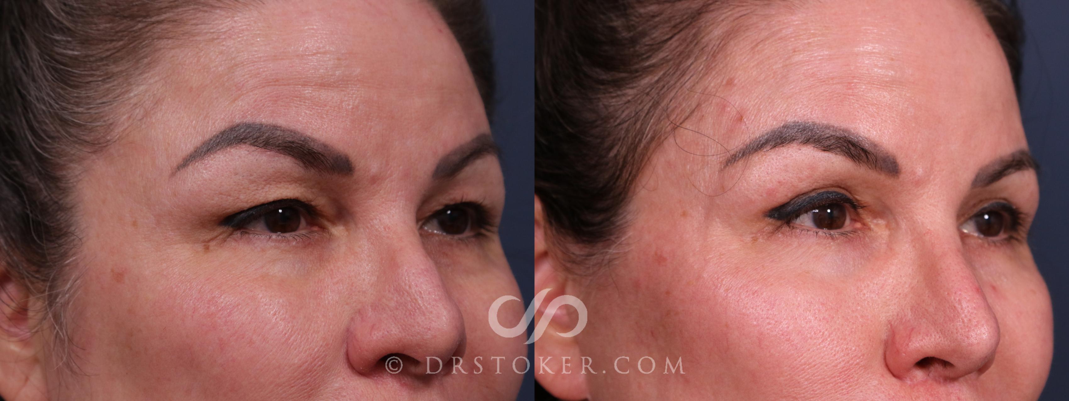 Before & After Eyelid Surgery Case 2317 Right Oblique View in Los Angeles, CA