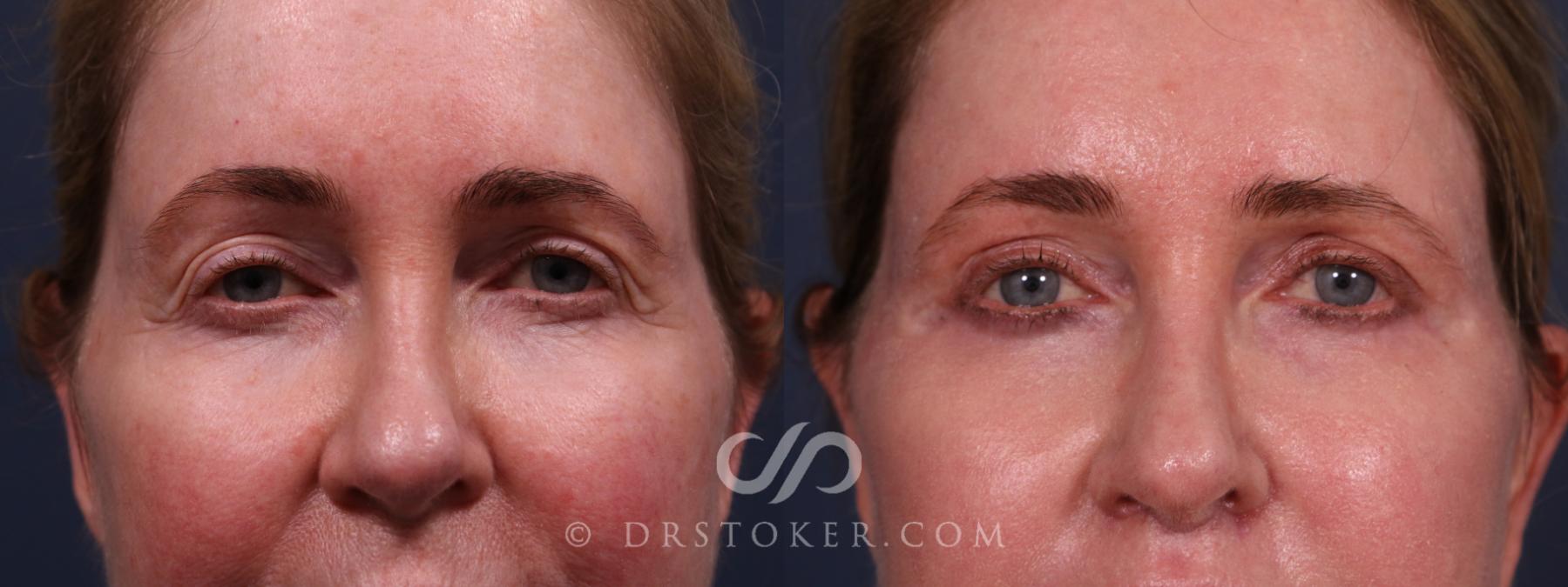 Before & After Eyelid Surgery Case 2341 Front View in Los Angeles, CA