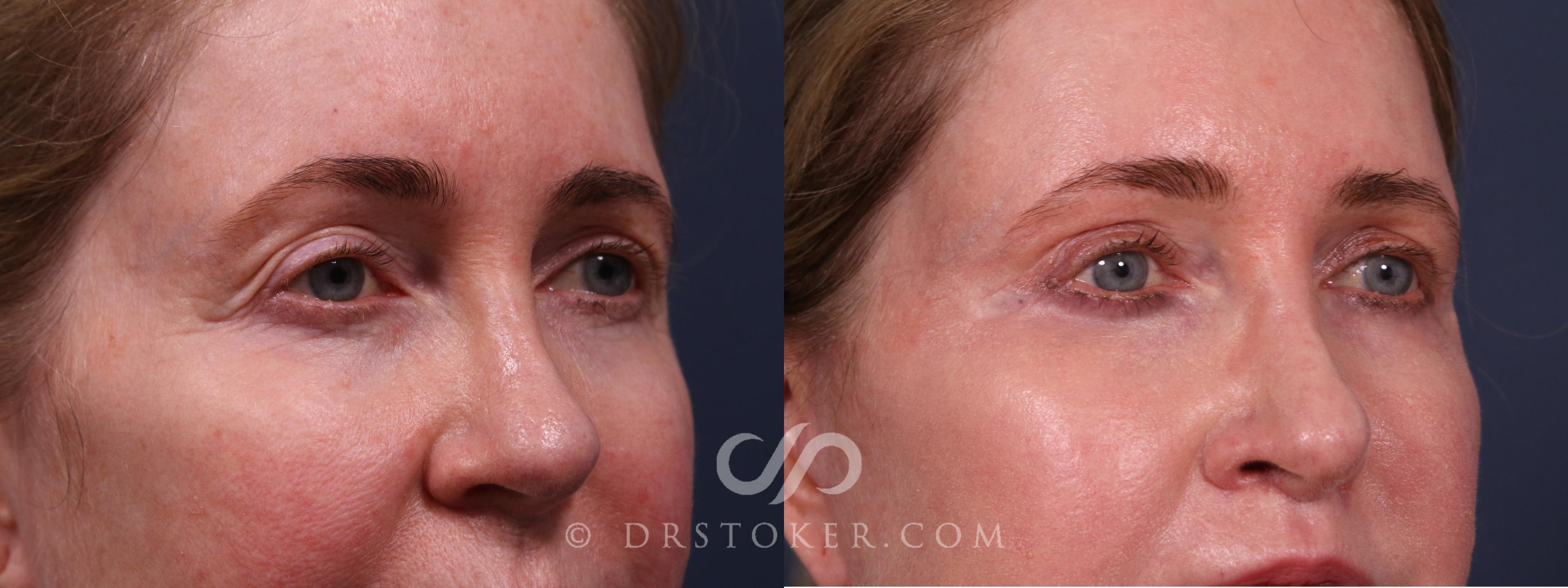 Before & After Eyelid Surgery Case 2341 Right Oblique View in Los Angeles, CA