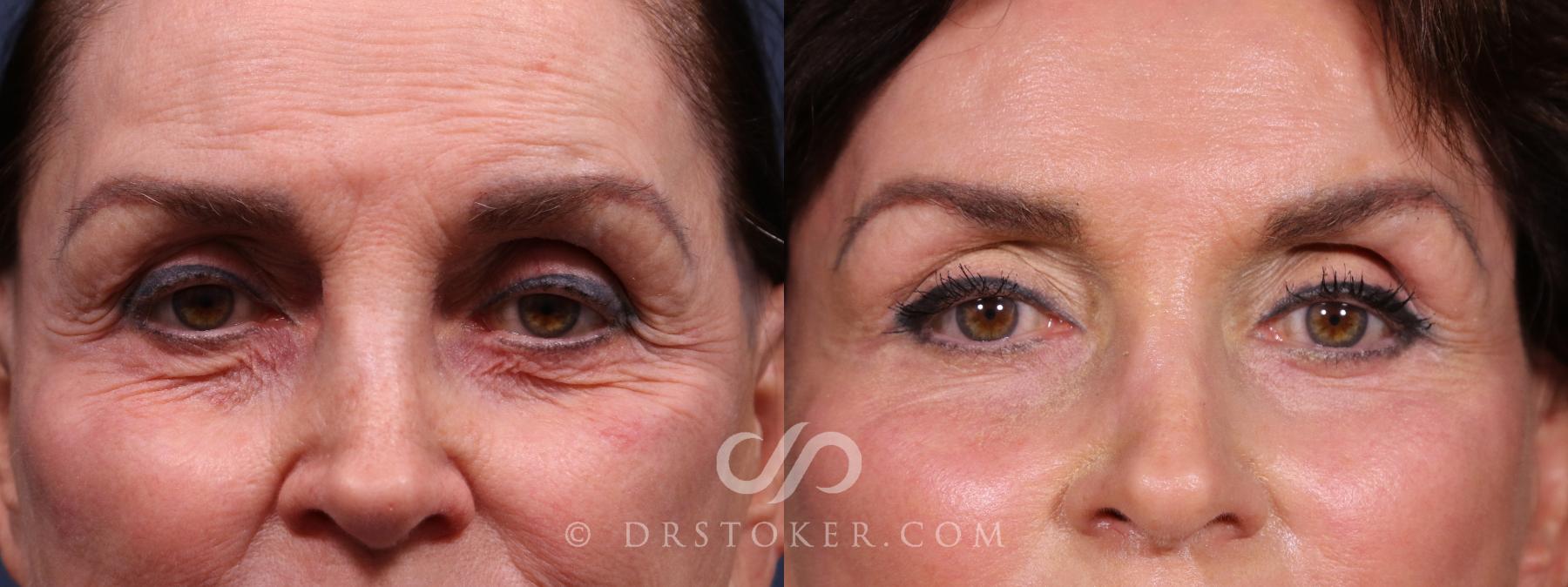 Before & After Eyelid Surgery Case 2343 Left Side View in Los Angeles, CA