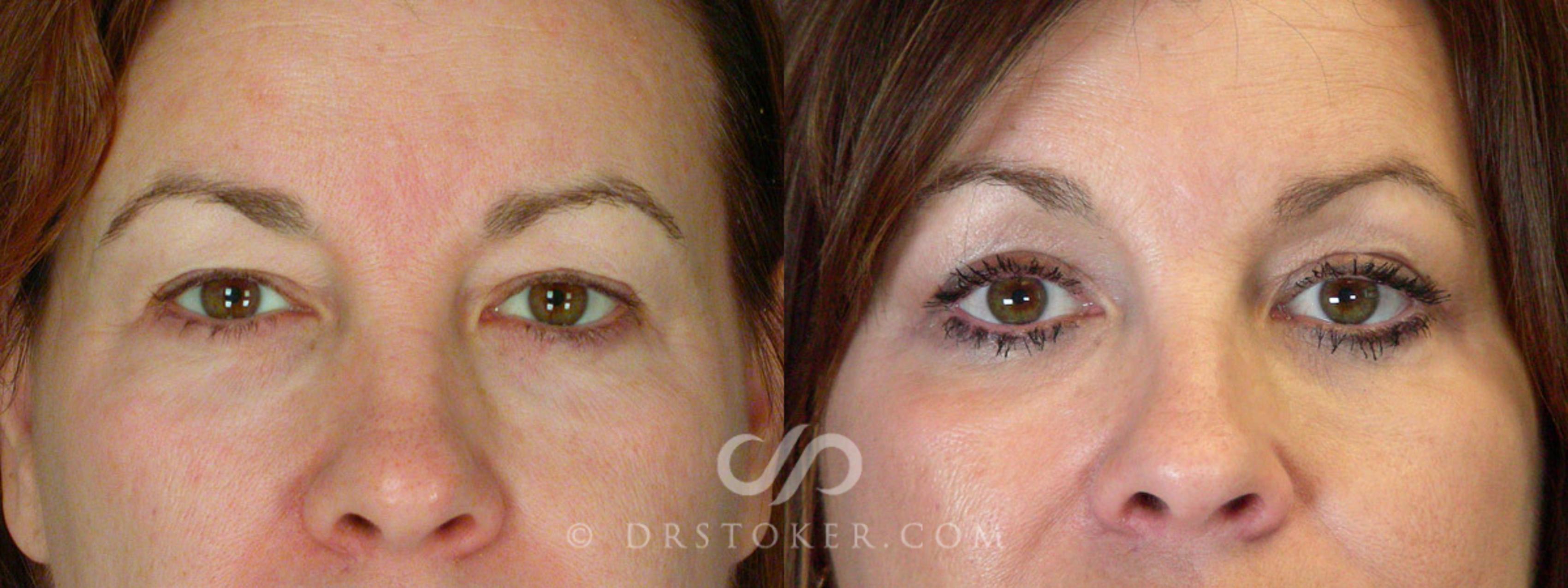 Before & After Eyelid Surgery Case 245 View #1 View in Los Angeles, CA