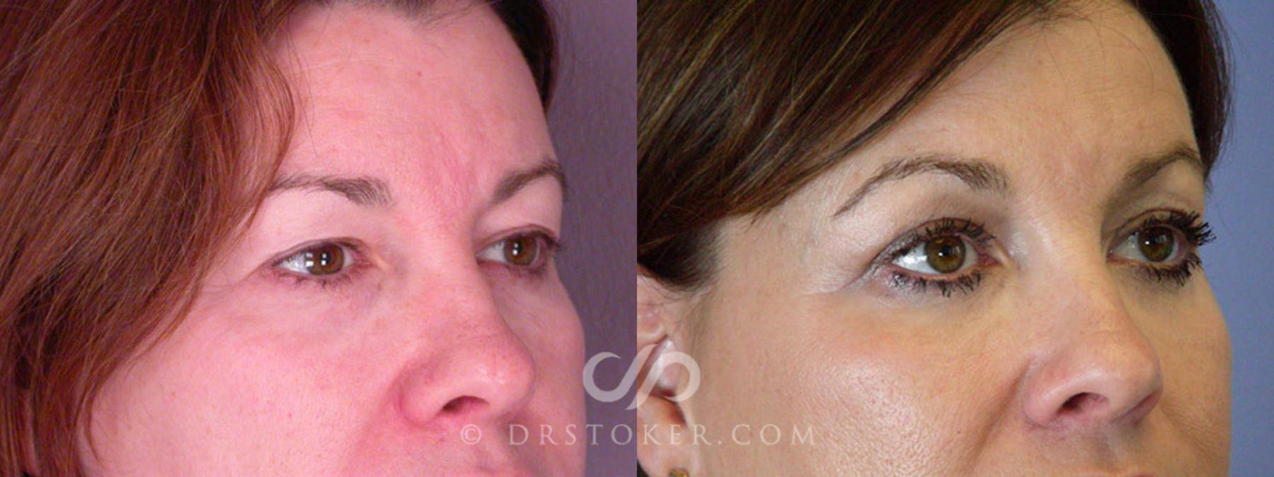 Before & After Eyelid Surgery Case 245 View #2 View in Los Angeles, CA