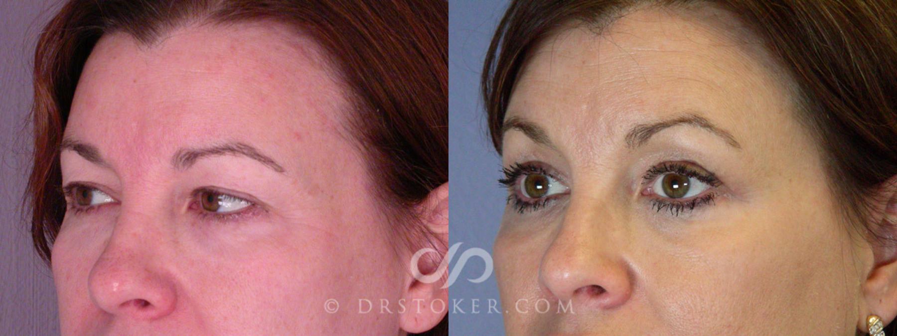 Before & After Eyelid Surgery Case 245 View #3 View in Los Angeles, CA