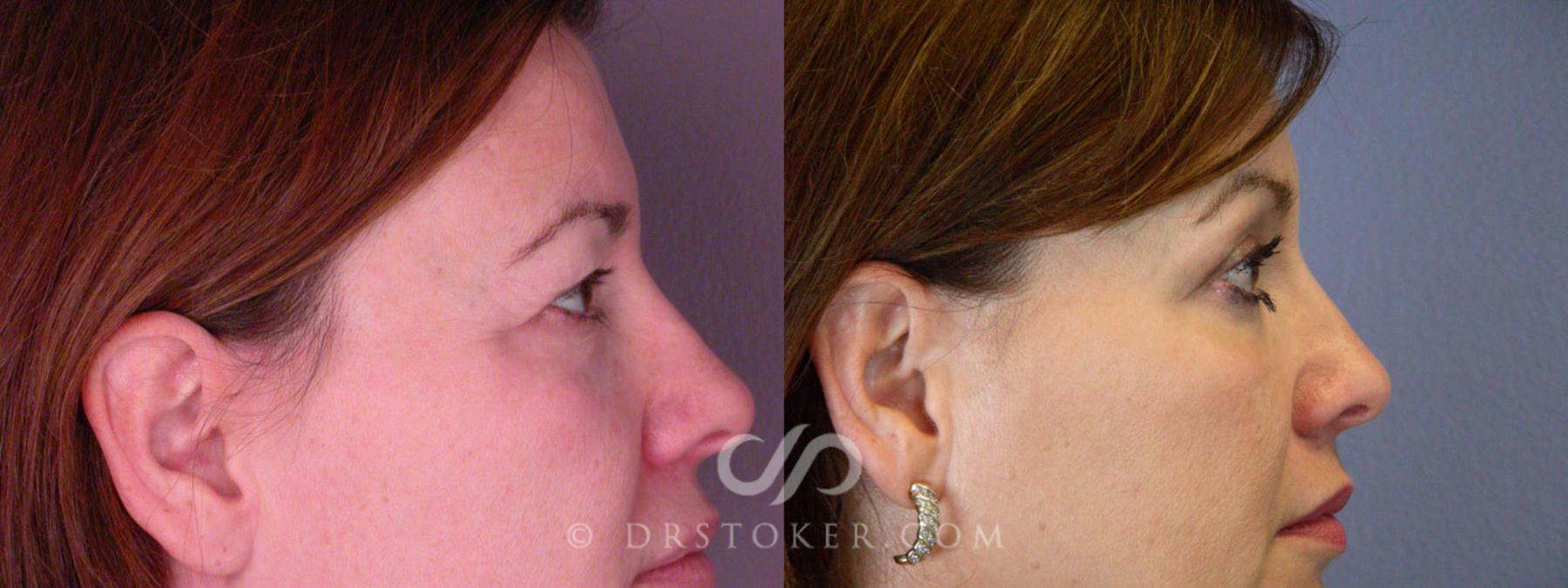 Before & After Eyelid Surgery Case 245 View #4 View in Los Angeles, CA