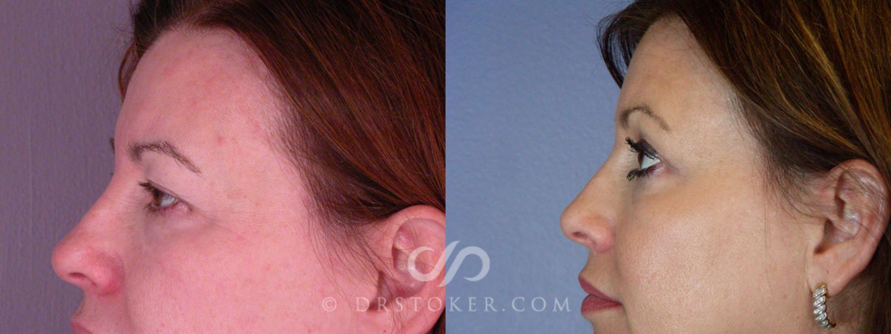Before & After Eyelid Surgery Case 245 View #5 View in Los Angeles, CA