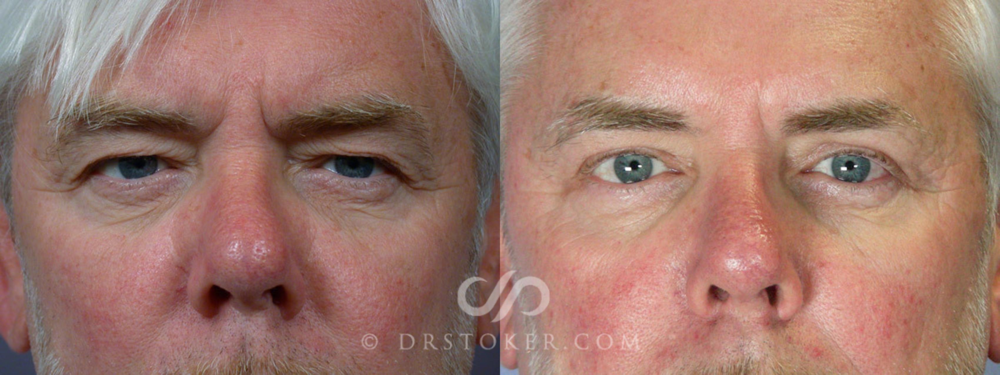 Before & After Eyelid Surgery for Men Case 246 View #1 View in Marina del Rey, CA